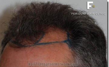 Hair restoration procedure results