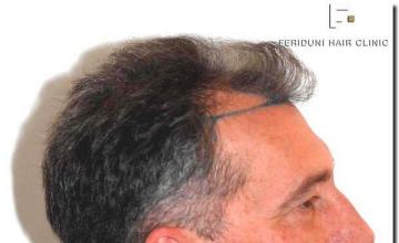 Hair restoration procedure results