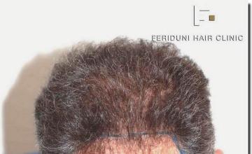 Hair restoration procedure results