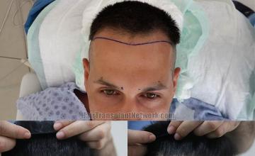 Hair restoration procedure before and after results