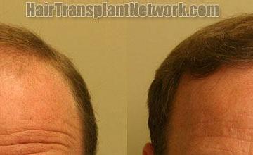 Before and after hair restoration procedure photos