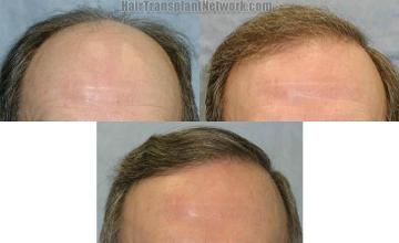 Hair transplantation surgery before and after images