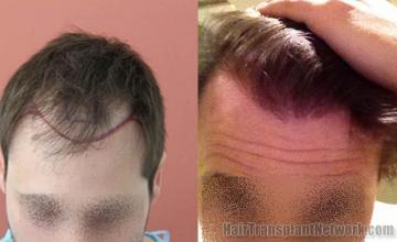 Hair transplantation surgery before and after photos