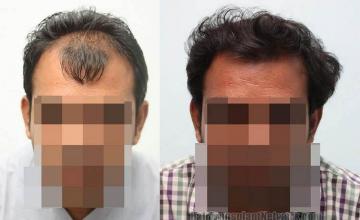 Front view - Before and after