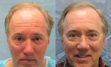 Hair transplantation surgery before and after photos