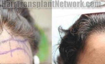 Hair restoration procedure before and after results