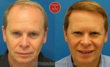 Front view - Before and after hair transplant surgery