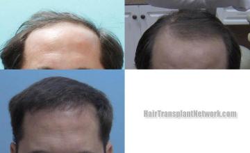 Front view - Before and after 