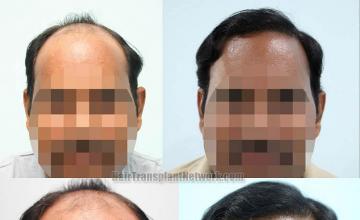 Front view - Before and after