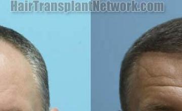 Front view - Before and after  