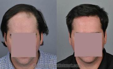 Before and after hair transplantation result photographs