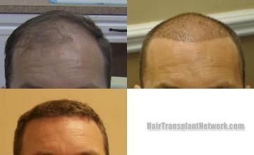 Front view - Before and after  