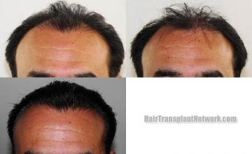 Front view - Before and after