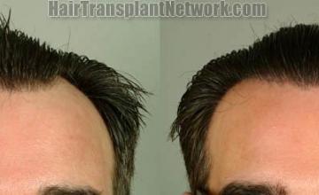 Front view - Before and after
