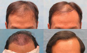 Front view - Before and after
