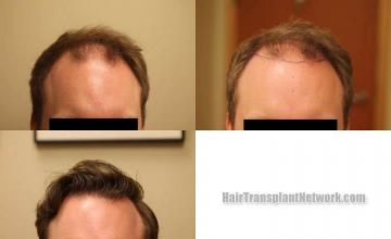 Front view - Before and after transplantation surgery