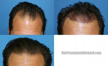 Front view - Before and after