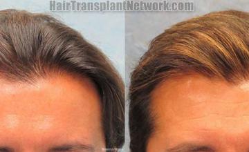 Front view - Before and after