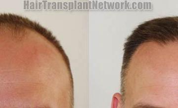 Front view - Before and after