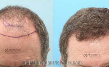 Front view - Before and after