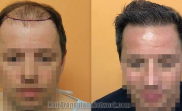 Front view - Before and after