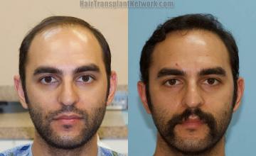 Front view - Before and after
