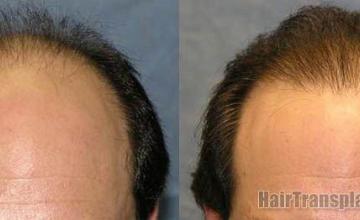  before and after first session