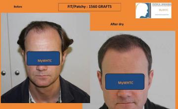 Hair restoration procedure before and after results