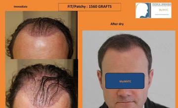 Hair restoration surgery before and after photos