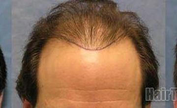 Hair restoration results before and after two sessions