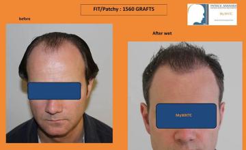 Hair transplantation surgery before and after pictures