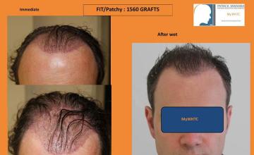 Hair restoration procedure before and after pictures