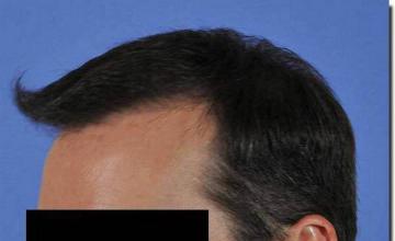 Hair restoration procedure results