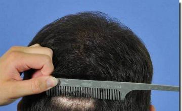 Hair restoration procedure results