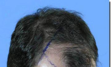 Hair restoration procedure results