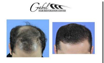 Hair restoration procedure results