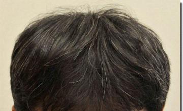 Hair restoration procedure results