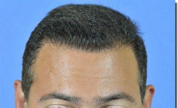 Hair restoration procedure results