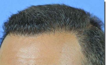 Hair restoration procedure results