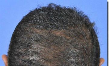 Hair restoration procedure results