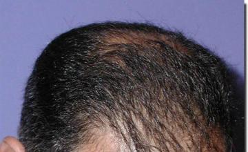 Hair restoration procedure results