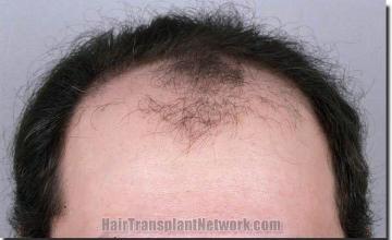 Hair restoration procedure results