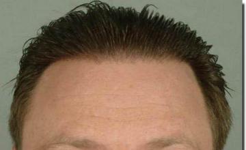 Hair restoration procedure results