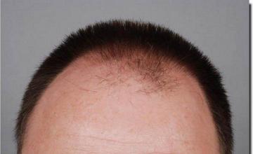 Hair restoration procedure results