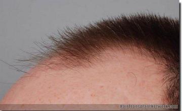 Hair restoration procedure results