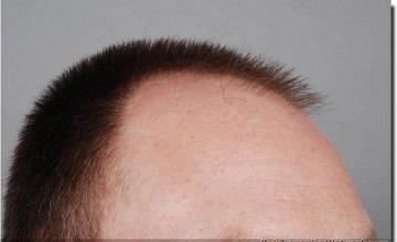 Hair restoration procedure results