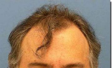 Hair restoration procedure results