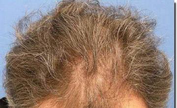 Hair restoration procedure results