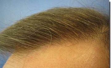 Hair restoration procedure results