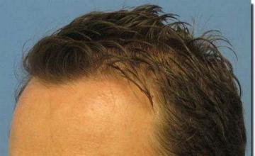 Hair restoration procedure results